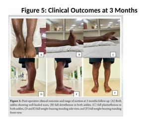 Single-Incision Internal Fixation Technique for Distal Tibia and Fibula ...