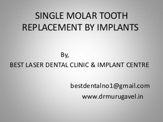 SINGLE MOLAR TOOTH
REPLACEMENT BY IMPLANTS
By,
BEST LASER DENTAL CLINIC & IMPLANT CENTRE
bestdentalno1@gmail.com
www.drmurugavel.in
 