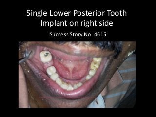 Single Lower Posterior Tooth Implant on right side 
Success Story No. 4615  