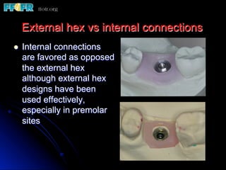 l  Internal connections
are favored as opposed
the external hex
although external hex
designs have been
used effectively,
especially in premolar
sites
External hex vs internal connections
 