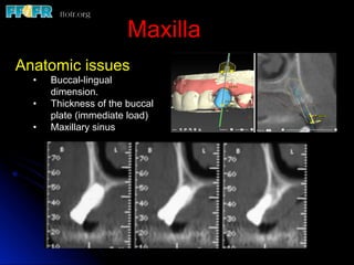 Anatomic issues
•  Buccal-lingual
dimension.
•  Thickness of the buccal
plate (immediate load)
•  Maxillary sinus
Maxilla
 