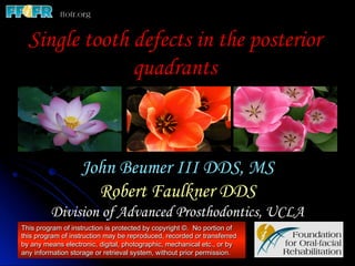 Single tooth defects in the posterior
quadrants
John Beumer III DDS, MS
Robert Faulkner DDS
Division of Advanced Prosthodontics, UCLA
This program of instruction is protected by copyright ©. No portion of
this program of instruction may be reproduced, recorded or transferred
by any means electronic, digital, photographic, mechanical etc., or by
any information storage or retrieval system, without prior permission.
 