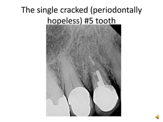 The single cracked (periodontally hopeless) #5 tooth 