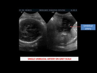 Umbilical artery SINGLE UMBILICAL ARTERY ON GREY SCALE 