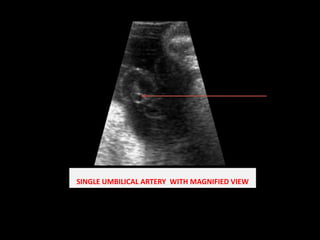 SINGLE UMBILICAL ARTERY  WITH MAGNIFIED VIEW