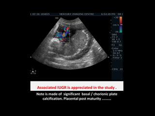 Associated IUGR is appreciated in the study .Note is made of  significant  basal / chorionic plate calcification. Placental post maturity .........