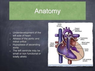 Anatomy
Underdevelopment of the
left side of heart
Atresia of the aortic and
mitral orifice
Hypoplasia of ascending
aorta
The left ventricle may be
small or non functional or
totally atretic
 