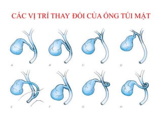 CÁC VỊ TRÍ THAY ĐỔI CỦA ỐNG TÚI MẬT
 
