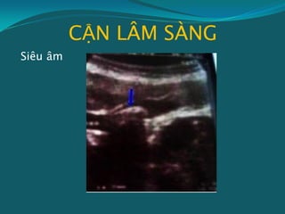 CẬN LÂM SÀNG
Siêu âm
 