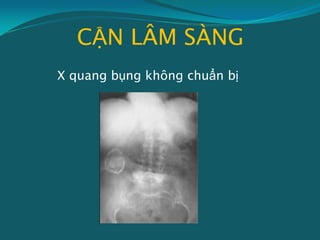 CẬN LÂM SÀNG
X quang bụng không chuẩn bị
 