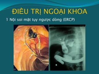 ĐIỀU TRỊ NGOẠI KHOA
1 Nội soi mật tụy ngược dòng (ERCP)
 