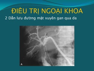 ĐIỀU TRỊ NGOẠI KHOA
2 Dẫn lưu đường mật xuyên gan qua da
 