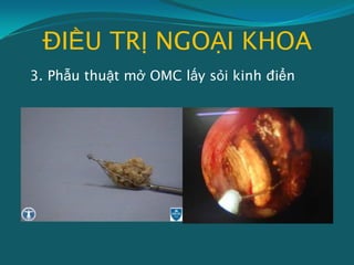 ĐIỀU TRỊ NGOẠI KHOA
3. Phẫu thuật mở OMC lấy sỏi kinh điển
 
