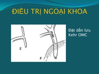 ĐIỀU TRỊ NGOẠI KHOA
Đặt dẫn lưu
Kehr OMC
 