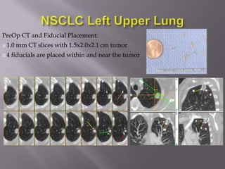 PreOp CT and Fiducial Placement:
 1.0   mm CT slices with 1.5x2.0x2.1 cm tumor
4   fiducials are placed within and near the tumor
 