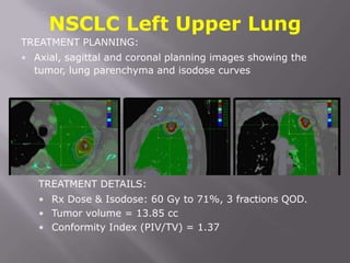NSCLC Left Upper Lung
TREATMENT PLANNING:
• Axial, sagittal and coronal planning images showing the
  tumor, lung parenchyma and isodose curves




   TREATMENT DETAILS:
   • Rx Dose & Isodose: 60 Gy to 71%, 3 fractions QOD.
   • Tumor volume = 13.85 cc
   • Conformity Index (PIV/TV) = 1.37
 