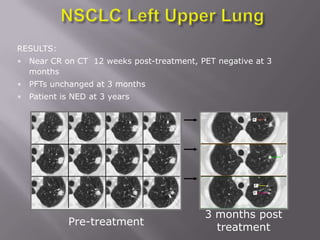 RESULTS:
• Near CR on CT 12 weeks post-treatment, PET negative at 3
  months
• PFTs unchanged at 3 months
• Patient is NED at 3 years




                                          3 months post
            Pre-treatment
                                            treatment
 