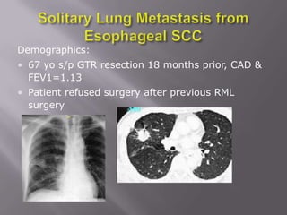 Demographics:
• 67 yo s/p GTR resection 18 months prior, CAD &
  FEV1=1.13
• Patient refused surgery after previous RML
  surgery
 