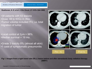 Rusthoven, K. E. et al. J Clin Oncol; 27:1579-1584 2009


•38 patients with 63 lesions
•Dose: 48 to 60Gy in 3fxs
•Tumor volume included ITV, i.e. total
migration of tumor


•Local control at 2yrs = 96%
•Median survival = 19 mo.

•Grade 3 toxicity 8% (almost all skin)
•1 case of symptomatic pneumonitis
                                                               Pre - tx                     Post tx

Fig 1. Images from a right lower lobe (RLL) lesion before and after stereotactic body radiation therapy
                                                (SBRT)

 Copyright © American Society of Clinical Oncology
 