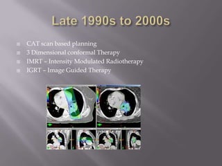    CAT scan based planning
   3 Dimensional conformal Therapy
   IMRT – Intensity Modulated Radiotherapy
   IGRT – Image Guided Therapy
 
