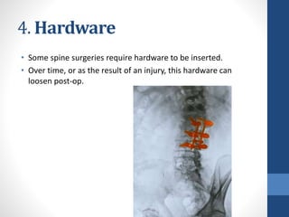 4. Hardware
• Some spine surgeries require hardware to be inserted.
• Over time, or as the result of an injury, this hardware can
loosen post-op.
 