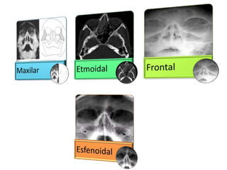 Factores LocorregionalesConstituye  el 5% de los casos de sinusitis. Antecedentes traumáticos ya sea directos o en forma de barotraumas