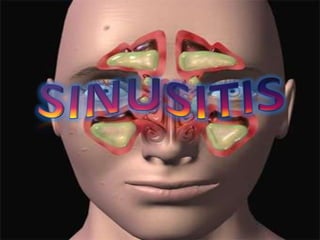 Sinusitis,[object Object]