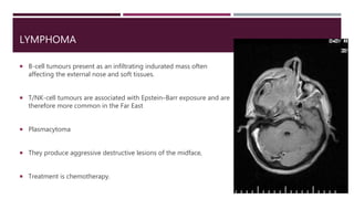 LYMPHOMA
 B-cell tumours present as an infiltrating indurated mass often
affecting the external nose and soft tissues.
 T/NK-cell tumours are associated with Epstein–Barr exposure and are
therefore more common in the Far East
 Plasmacytoma
 They produce aggressive destructive lesions of the midface,
 Treatment is chemotherapy.
 