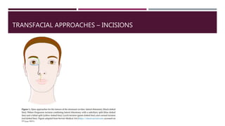 TRANSFACIAL APPROACHES – INCISIONS
 