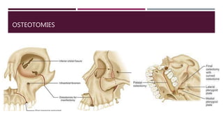 OSTEOTOMIES
 