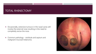 TOTAL RHINECTOMY
 Occasionally, extensive tumours in the nasal cavity will
involve the external nose resulting in the need to
completely excise the nose.
 Common pathology - vestibule and septum and
malignant mucosal melanoma.
 