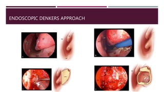 ENDOSCOPIC DENKERS APPROACH
 