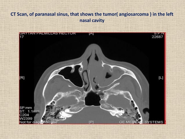 Tumours of nasal cavity & paranasal sinuses | PDF | Ear, Nose and ...