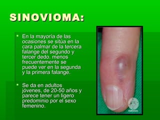 SSIINNOOVVIIOOMMAA:: 
 EEnn llaa mmaayyoorrííaa ddee llaass 
ooccaassiioonneess ssee ssiittúúaa eenn llaa 
ccaarraa ppaallmmaarr ddee llaa tteerrcceerraa 
ffaallaannggee ddeell sseegguunnddoo yy 
tteerrcceerr ddeeddoo.. mmeennooss 
ffrreeccuueenntteemmeennttee ssee 
ppuueeddee vveerr eenn llaa sseegguunnddaa 
yy llaa pprriimmeerraa ffaallaannggee.. 
 SSee ddaa eenn aadduullttooss 
jjóóvveenneess,, ddee 2200--5500 aaññooss yy 
ppaarreeccee tteenneerr uunn lliiggeerroo 
pprreeddoommiinniioo ppoorr eell sseexxoo 
ffeemmeenniinnoo.. 
 