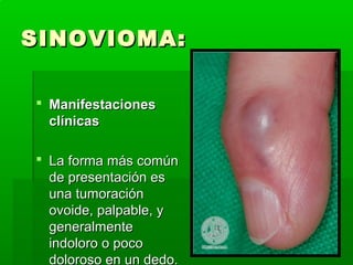 SSIINNOOVVIIOOMMAA:: 
 MMaanniiffeessttaacciioonneess 
ccllíínniiccaass 
 LLaa ffoorrmmaa mmááss ccoommúúnn 
ddee pprreesseennttaacciióónn eess 
uunnaa ttuummoorraacciióónn 
oovvooiiddee,, ppaallppaabbllee,, yy 
ggeenneerraallmmeennttee 
iinnddoolloorroo oo ppooccoo 
ddoolloorroossoo eenn uunn ddeeddoo.. 
 