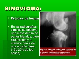 SSIINNOOVVIIOOMMAA:: 
 EEssttuuddiiooss ddee iimmaaggeenn 
 EEnn llaass rraaddiiooggrraaffííaass 
ssiimmpplleess ssee oobbsseerrvvaa 
uunnaa mmaassaa ddeennssaa ddee 
ppaarrtteess bbllaannddaass,, bbiieenn 
cciirrccuunnssccrriittaa yy aa 
mmeennuuddoo cceerrccaa ddee 
uunnaa eerroossiióónn óósseeaa 
(1155aa 2200%% ddee llooss 
ccaassooss)).. 
 