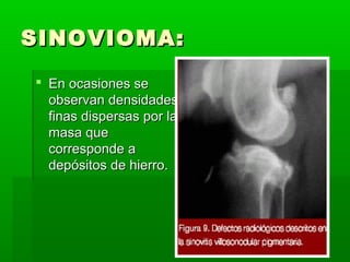 SSIINNOOVVIIOOMMAA:: 
 EEnn ooccaassiioonneess ssee 
oobbsseerrvvaann ddeennssiiddaaddeess 
ffiinnaass ddiissppeerrssaass ppoorr llaa 
mmaassaa qquuee 
ccoorrrreessppoonnddee aa 
ddeeppóóssiittooss ddee hhiieerrrroo.. 
 