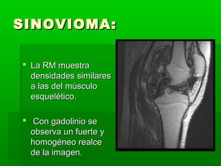 SSIINNOOVVIIOOMMAA:: 
 LLaa RRMM mmuueessttrraa 
ddeennssiiddaaddeess ssiimmiillaarreess 
aa llaass ddeell mmúússccuulloo 
eessqquueellééttiiccoo.. 
 CCoonn ggaaddoolliinniioo ssee 
oobbsseerrvvaa uunn ffuueerrttee yy 
hhoommooggéénneeoo rreeaallccee 
ddee llaa iimmaaggeenn.. 
 