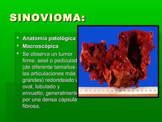 SSIINNOOVVIIOOMMAA:: 
 AAnnaattoommííaa ppaattoollóóggiiccaa 
 MMaaccrroossccóóppiiccaa 
 SSee oobbsseerrvvaa uunn ttuummoorr 
ffiirrmmee,, sseessiill oo ppeeddiiccuullaaddoo 
((ddee ddiiffeerreennttee ttaammaaññooss eenn 
llaass aarrttiiccuullaacciioonneess mmááss 
ggrraannddeess)) rreeddoonnddeeaaddoo uu 
oovvaall,, lloobbuullaaddoo yy 
eennvvuueellttoo,, ggeenneerraallmmeennttee,, 
ppoorr uunnaa ddeennssaa ccááppssuullaa 
ffiibbrroossaa.. 
 