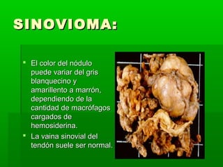 SSIINNOOVVIIOOMMAA:: 
 EEll ccoolloorr ddeell nnóódduulloo 
ppuueeddee vvaarriiaarr ddeell ggrriiss 
bbllaannqquueecciinnoo yy 
aammaarriilllleennttoo aa mmaarrrróónn,, 
ddeeppeennddiieennddoo ddee llaa 
ccaannttiiddaadd ddee mmaaccrróóffaaggooss 
ccaarrggaaddooss ddee 
hheemmoossiiddeerriinnaa.. 
 LLaa vvaaiinnaa ssiinnoovviiaall ddeell 
tteennddóónn ssuueellee sseerr nnoorrmmaall.. 
 