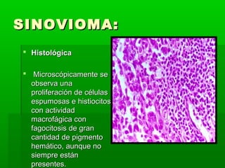 SSIINNOOVVIIOOMMAA:: 
 HHiissttoollóóggiiccaa 
 MMiiccrroossccóóppiiccaammeennttee ssee 
oobbsseerrvvaa uunnaa 
pprroolliiffeerraacciióónn ddee ccéélluullaass 
eessppuummoossaass ee hhiissttiioocciittooss 
ccoonn aaccttiivviiddaadd 
mmaaccrrooffáággiiccaa ccoonn 
ffaaggoocciittoossiiss ddee ggrraann 
ccaannttiiddaadd ddee ppiiggmmeennttoo 
hheemmááttiiccoo,, aauunnqquuee nnoo 
ssiieemmpprree eessttáánn 
pprreesseenntteess.. 
 