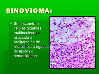 SSIINNOOVVIIOOMMAA:: 
 SSee eennccuueennttrraann 
ccéélluullaass ggiiggaanntteess 
mmuullttiinnuucclleeaaddaass 
aassoocciiaaddaa aa 
pprroolliiffeerraacciióónn ddee 
hhiissttiioocciittooss,, ccaarrggaaddooss 
ddee llííppiiddooss oo 
hheemmoossiiddeerriinnaa.. 
 