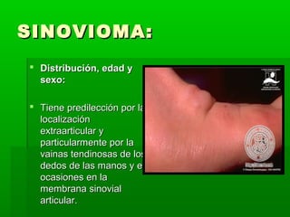 SSIINNOOVVIIOOMMAA:: 
 DDiissttrriibbuucciióónn,, eeddaadd yy 
sseexxoo:: 
 TTiieennee pprreeddiilleecccciióónn ppoorr llaa 
llooccaalliizzaacciióónn 
eexxttrraaaarrttiiccuullaarr yy 
ppaarrttiiccuullaarrmmeennttee ppoorr llaa 
vvaaiinnaass tteennddiinnoossaass ddee llooss 
ddeeddooss ddee llaass mmaannooss yy eenn 
ooccaassiioonneess eenn llaa 
mmeemmbbrraannaa ssiinnoovviiaall 
aarrttiiccuullaarr.. 
 