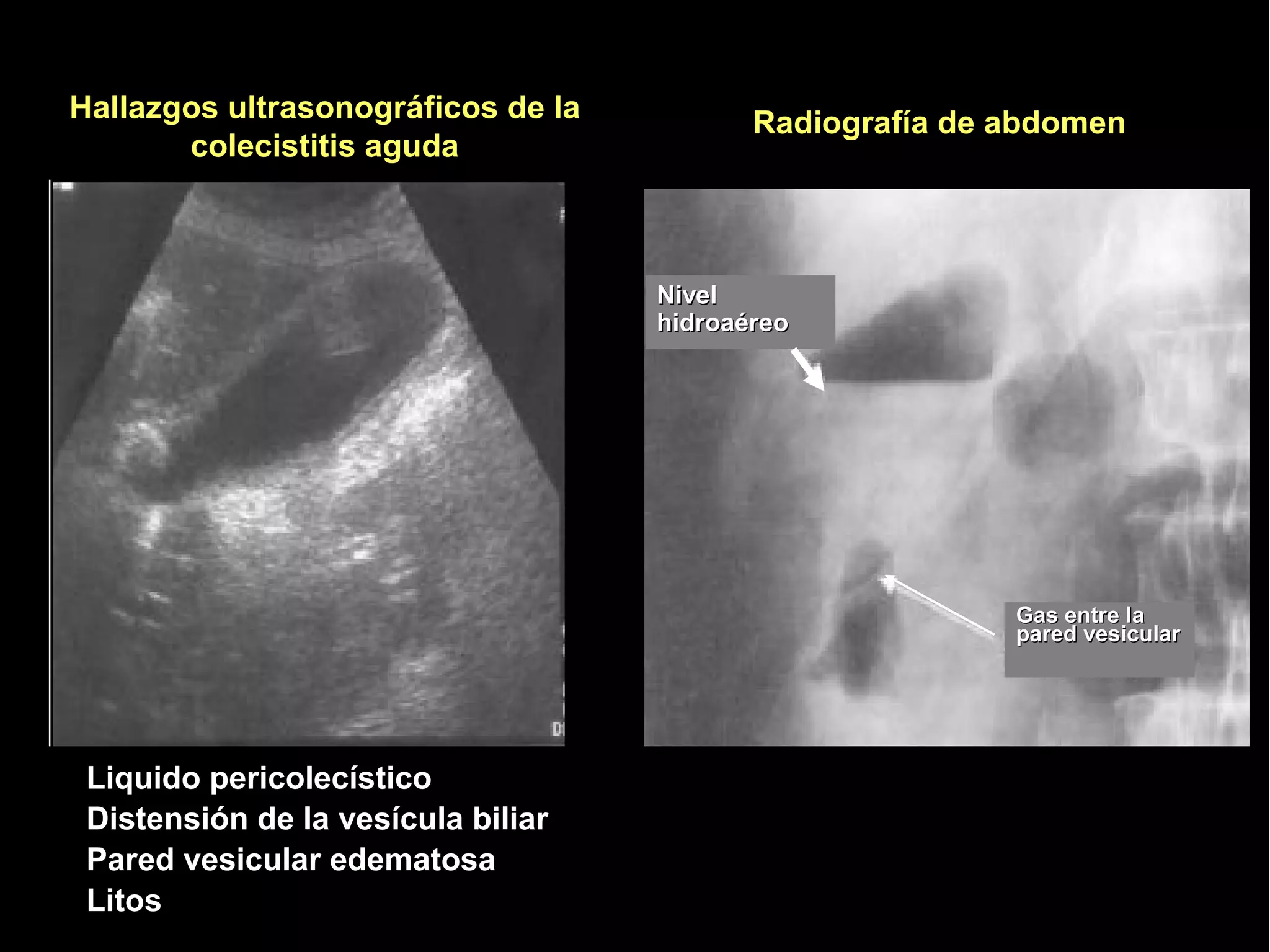 Hallazgos ultrasonográficos de la          Radiografía de abdomen
       colecistitis aguda



                                    Nivel
                                    hidroaéreo




                                                          Gas entre la
                                                          pared vesicular




 Liquido pericolecístico
 Distensión de la vesícula biliar
 Pared vesicular edematosa
 Litos
 