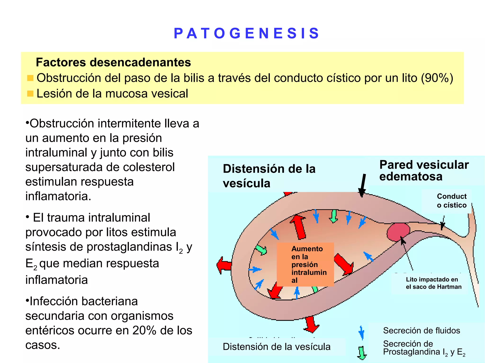 PATOGENESIS
 Factores desencadenantes
 Obstrucción del paso de la bilis a través del conducto cístico por un lito (90%)
 Lesión de la mucosa vesical

•Obstrucción intermitente lleva a
un aumento en la presión
intraluminal y junto con bilis
supersaturada de colesterol         Distensión de la              Pared vesicular
estimulan respuesta                                               edematosa
                                    vesícula
inflamatoria.                                                                     Conduct
                                                                                  o cístico
• El trauma intraluminal
provocado por litos estimula
síntesis de prostaglandinas I2 y                   Aumento
                                                   en la
E2 que median respuesta                            presión
                                                   intralumin
inflamatoria                                       al                    Lito impactado en
                                                                         el saco de Hartman

•Infección bacteriana
secundaria con organismos
entéricos ocurre en 20% de los                                     Secreción de fluidos
casos.                              Distensión de la vesícula      Secreción de
                                                                   Prostaglandina I2 y E2
 