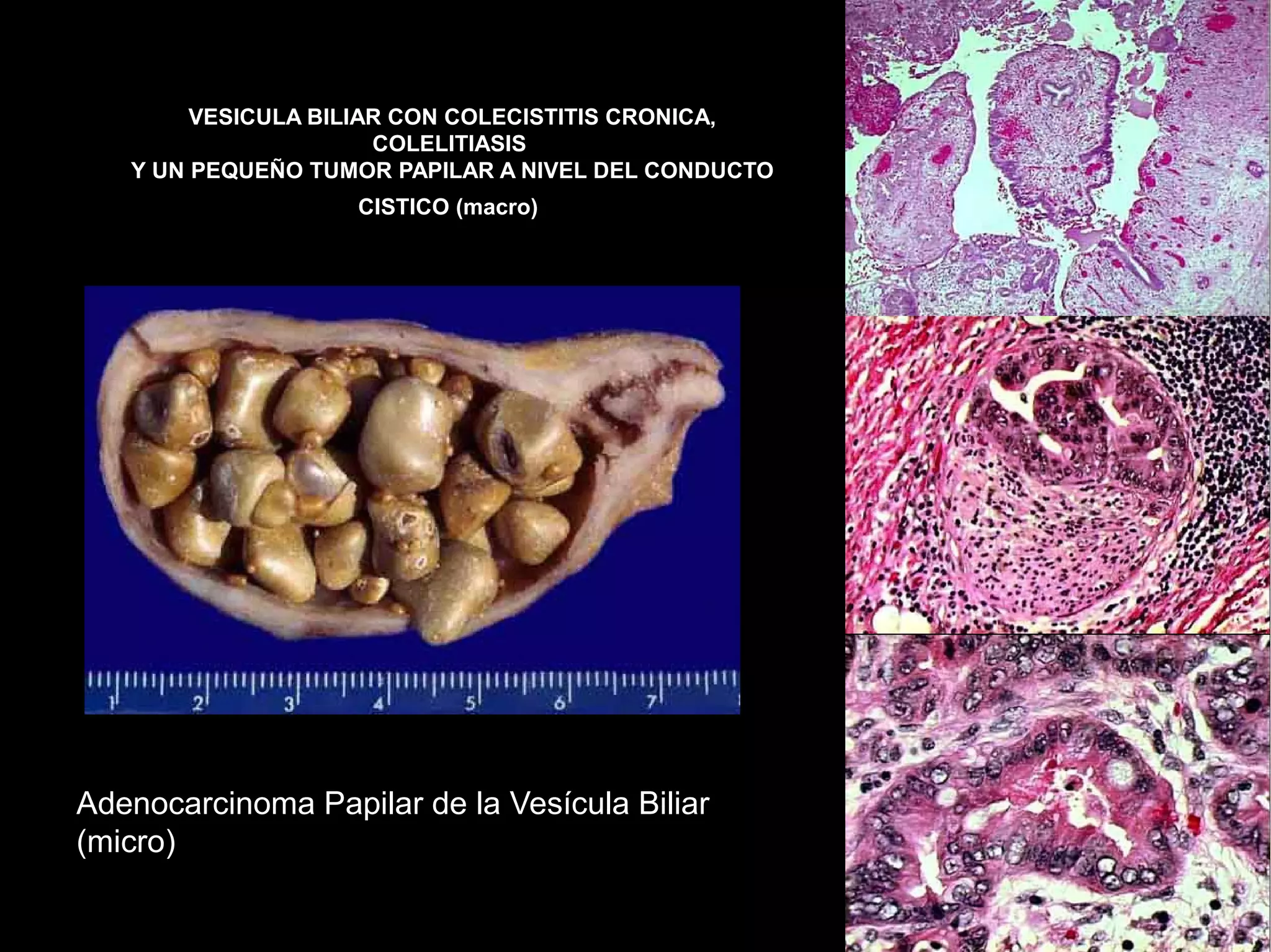 VESICULA BILIAR CON COLECISTITIS CRONICA,
                      COLELITIASIS
   Y UN PEQUEÑO TUMOR PAPILAR A NIVEL DEL CONDUCTO
                   CISTICO (macro)




Adenocarcinoma Papilar de la Vesícula Biliar
(micro)
 