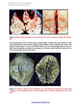 Sss Infarction Radiological pathology of cerebral venous & dural sinus thrombosis | PDF