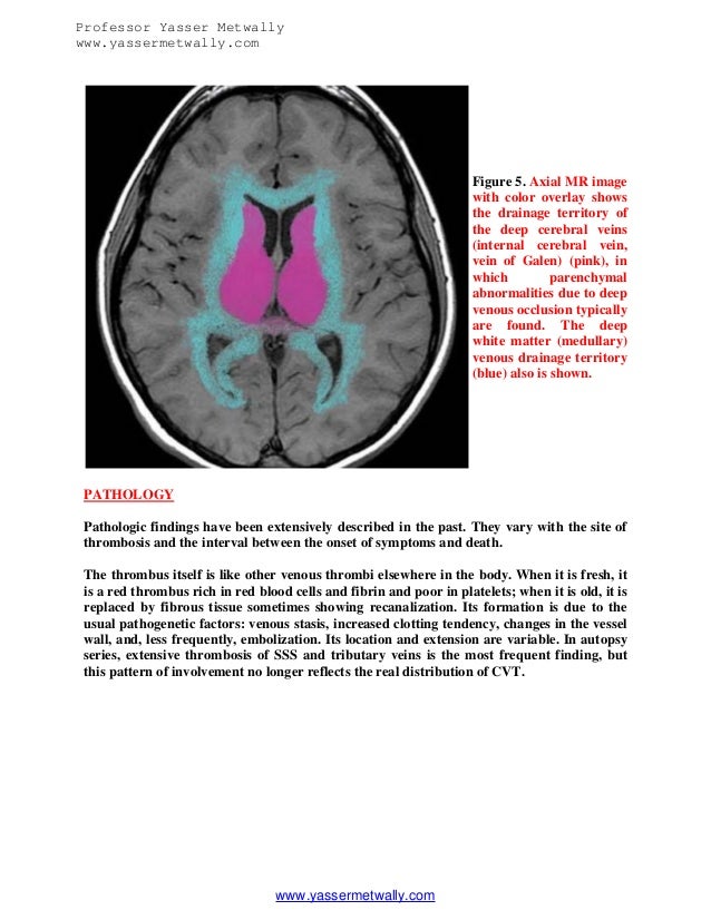 Radiological pathology of cerebral venous & dural sinus ...