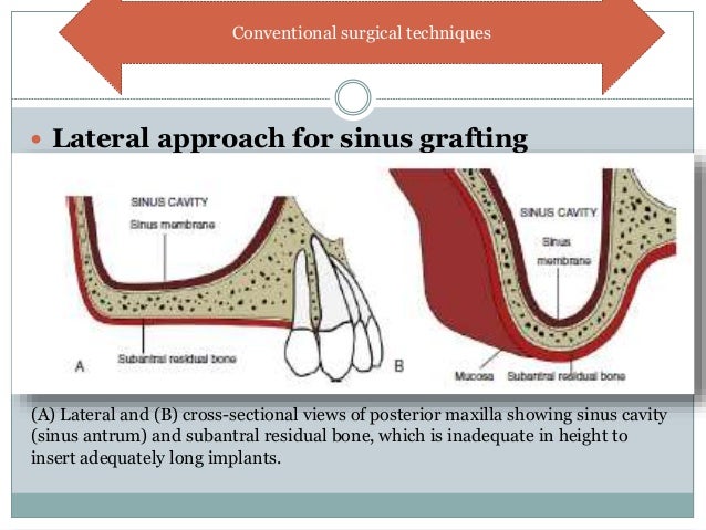 Sinus Lift With Implant Placement Surgical Approach