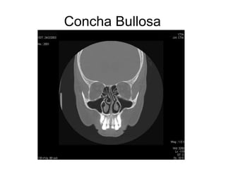Concha Bullosa
 